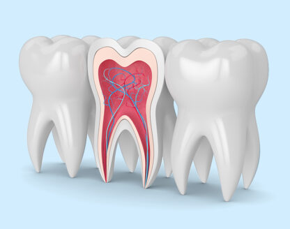 root-canal