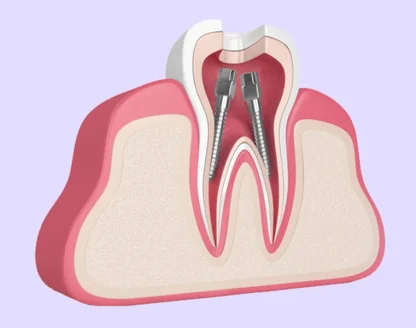 What Is A Root Canal Treatment And When Should You Get One? 
