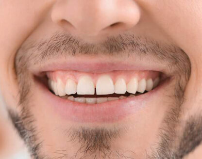 dental-implants-top-benefits