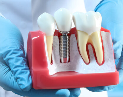 _Are tooth implants permanent
