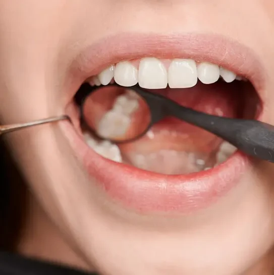Dental Fillings