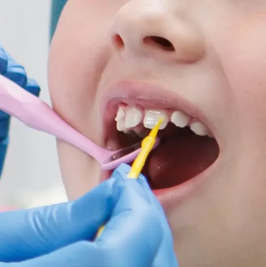 Dental Sealants