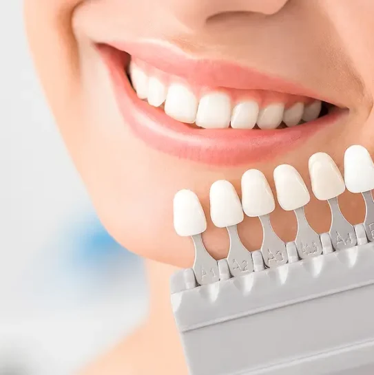Veneers