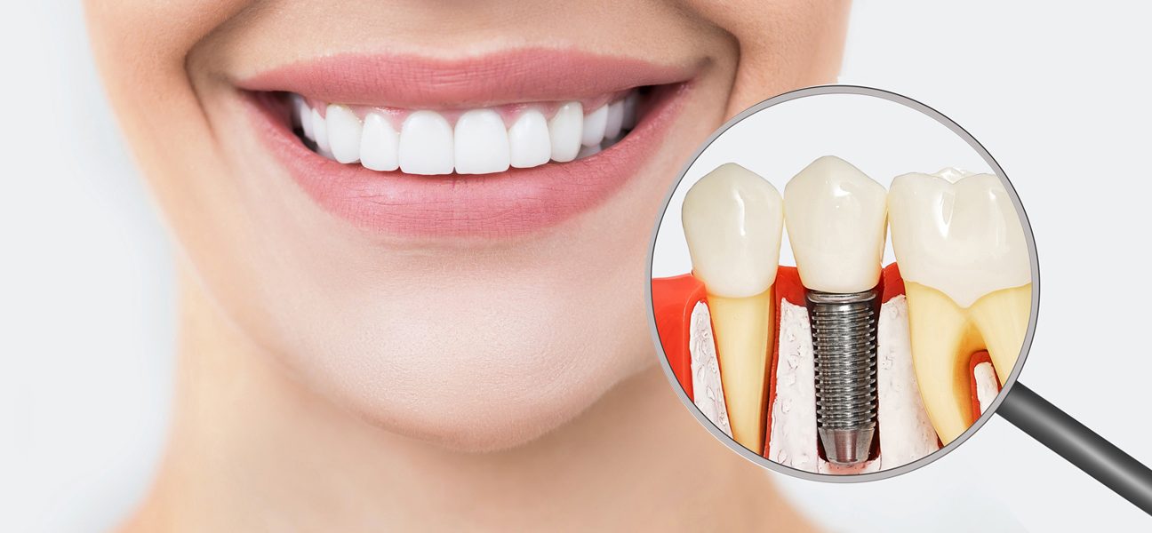 Same-Day Dental Implants: Get a New Smile in Just One Visit
