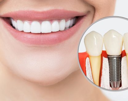 Same-Day Dental Implants: Get a New Smile in Just One Visit 
