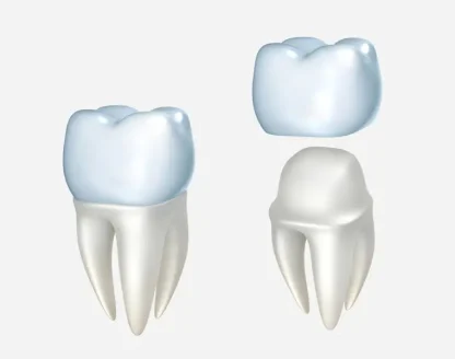 What Happens During a Same-Day Dental Crown Procedure? 